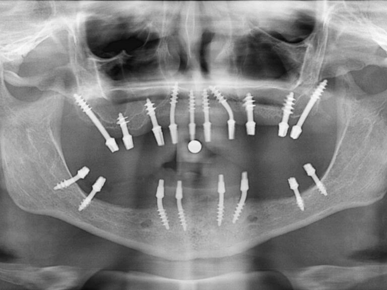 Что такое базальная имплантация зубов. Преимущества и недостатки