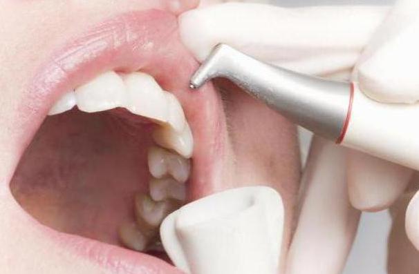 Что такое профессиональное отбеливание и чистка зубов Air Flow. Это лучше или хуже ультразвука?