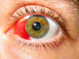 Опасное явление кровоизлияние в глаз