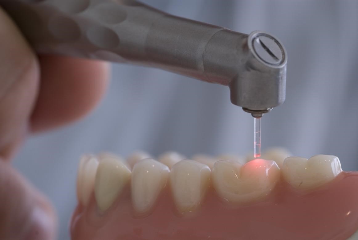 Методы лечения кисты зуба без удаления. Что будет, если не лечить