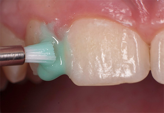 Возможно ли лечение кариеса молочных зубов без бормашины