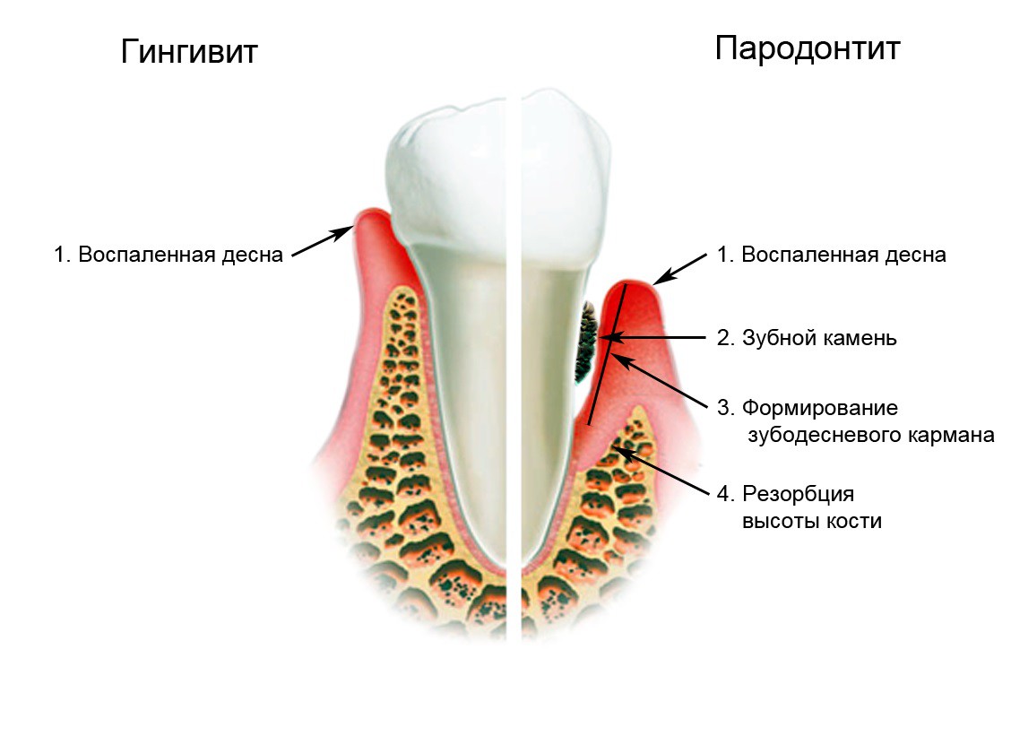 Инструкция по применению хлоргексидина для полоскания рта при воспалении дёсен и после удаления зуба