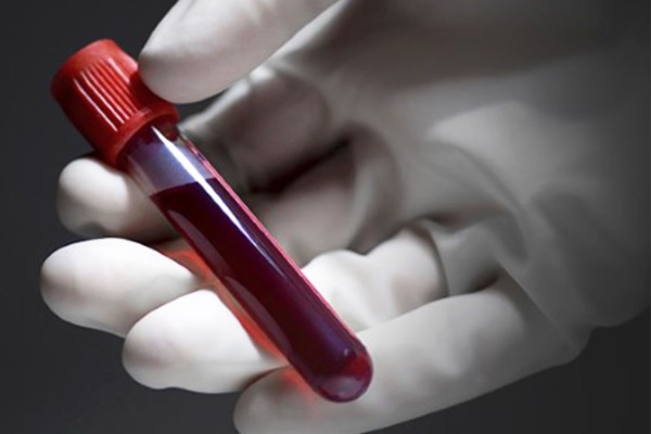 Анализ крови на антитела к ХГЧ