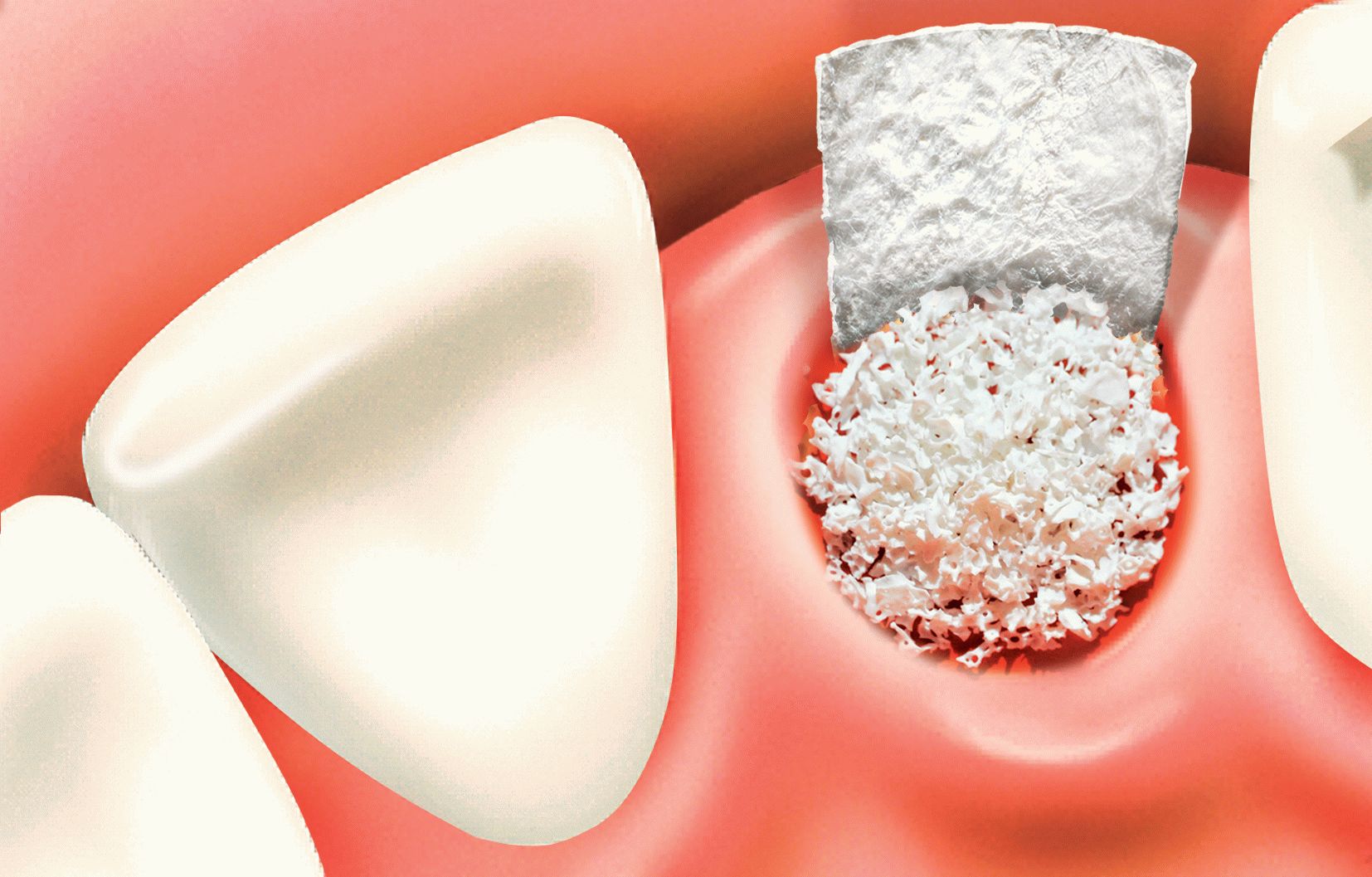 Способы наращивания костной ткани при имплантации зубов регенерация при атрофии кости