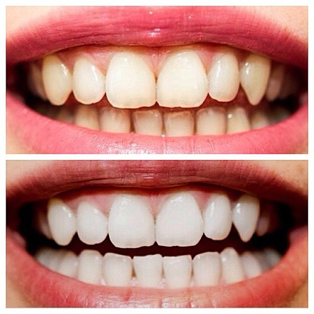 Какой способ отбеливания зубов самый щадящий и эффективный? Ищем самый безопасный метод