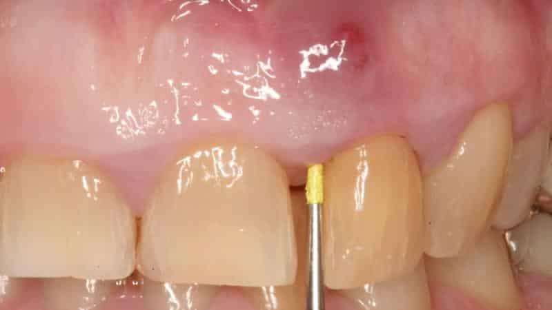 Чем вытянуть гной из десны: в стоматологии и в домашних условиях