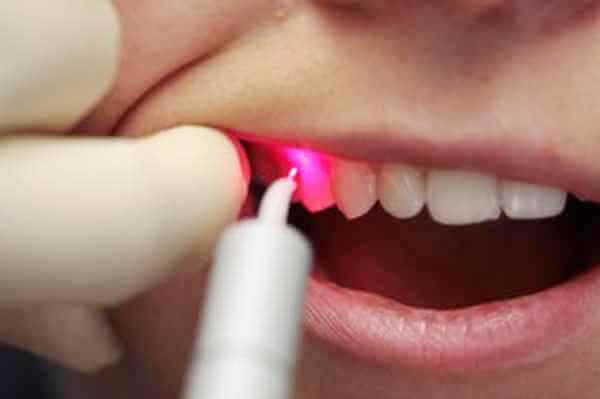 Лазерное десен. Лазерная стоматология. Стоматологический лазер. Препарирование зубов лазером. Лазерная терапия в стоматологии.
