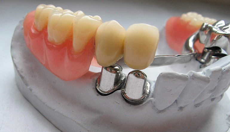 Что такое бюгельные зубные протезы и коронки. Описание, классификация, плюсы и минусы