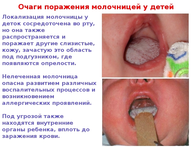 Почему появляется молочница у детей во рту, и как её лечить