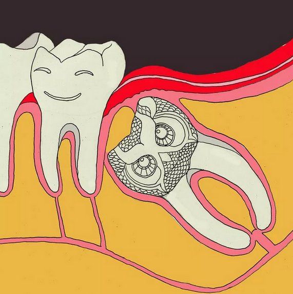Как происходит удаление зубов лазером? Преимущества метода