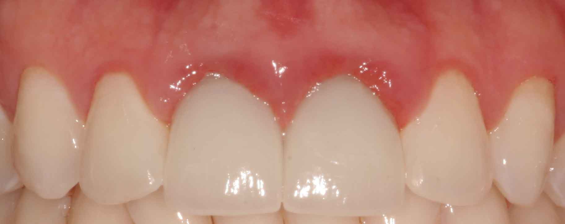 Что означает красная десна вокруг зуба у ребенка или у взрослого. Причины и лечение