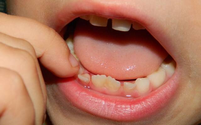 Почему у ребенка шатается молочный зуб? Что делать в этой ситуации