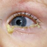 Глазные капли для детей от конъюктивита