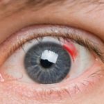 Опасное явление кровоизлияние в глаз