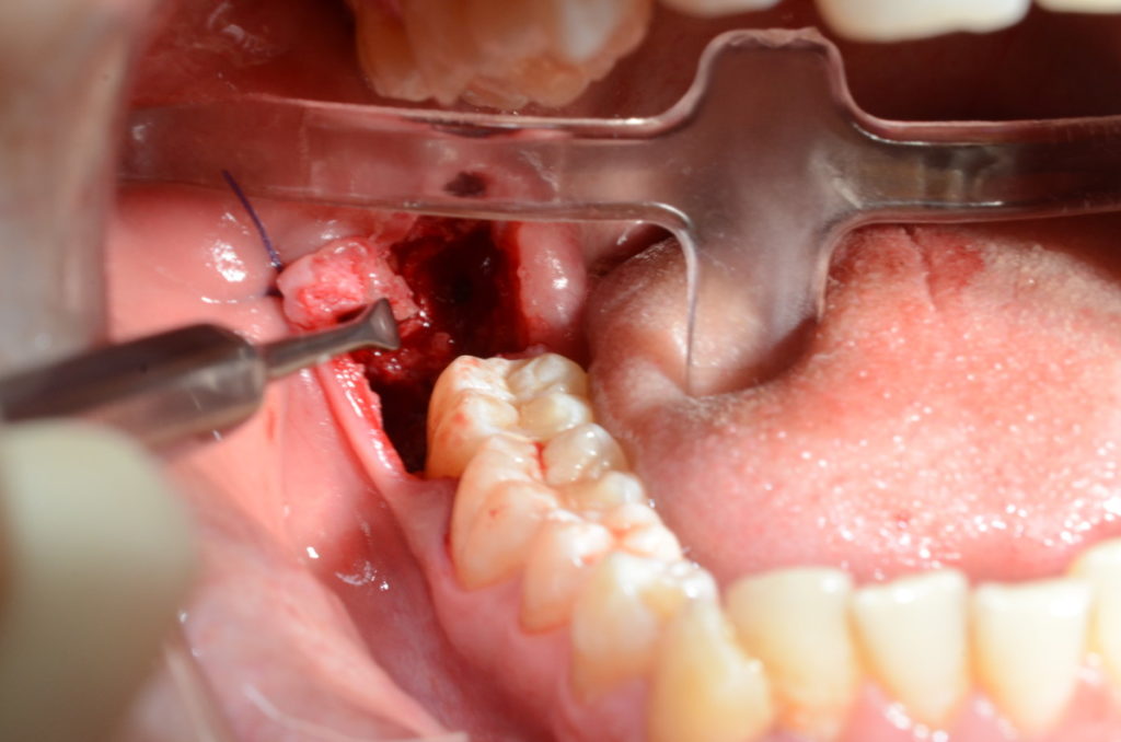 Как происходит удаление зуба мудрости, если он растет горизонтально и упирается в соседний зуб