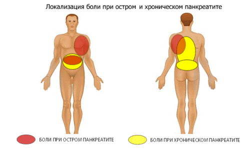 Боль в спине при панкреатите - распространенное явление, с которым сталкиваются пациенты, страдающие воспалением поджелудочной железы