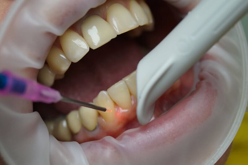 Как происходит удаление зубов лазером? Преимущества метода