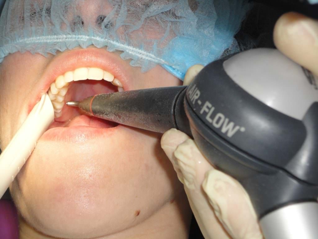 Что такое профессиональное отбеливание и чистка зубов Air Flow. Это лучше или хуже ультразвука?