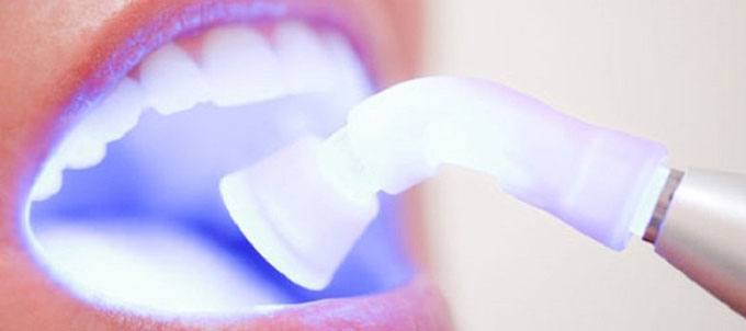 Что такое химическое отбеливание зубов. Эффективно, но не всегда безопасно