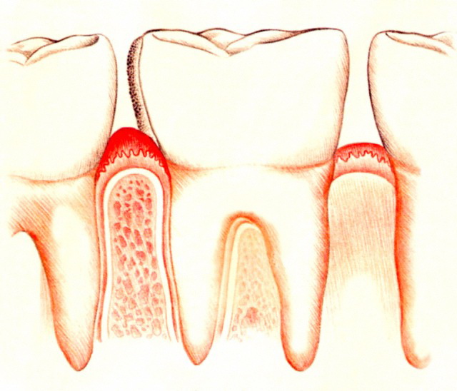 На чём держится зуб? Узнаем про строение и функции тканей пародонта, классификацию заболеваний и их профилактику
