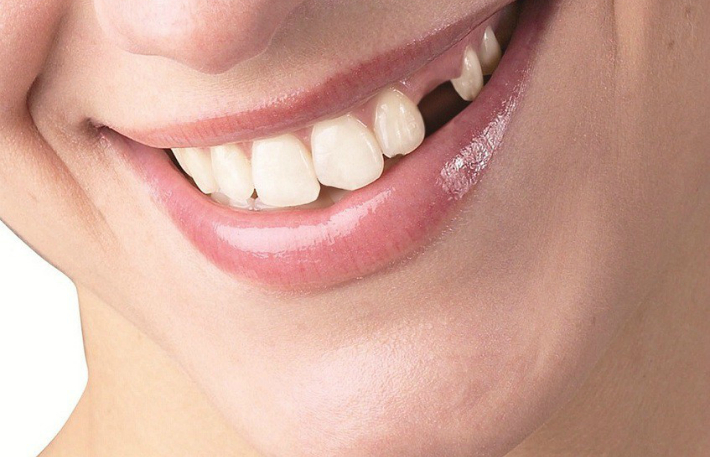 Какие противопоказания и возможные осложнения могут быть у имплантации зубов. Почему отторгаются импланты