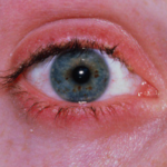 Блефарит глаза и его лечение