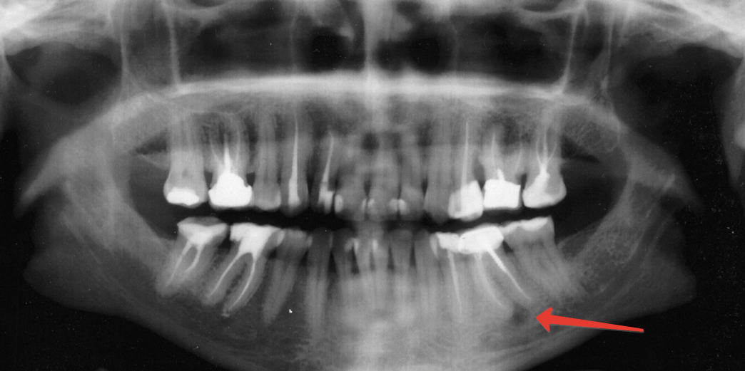 Что делать, если под коронкой образовалась киста зуба? Как избежать осложнений