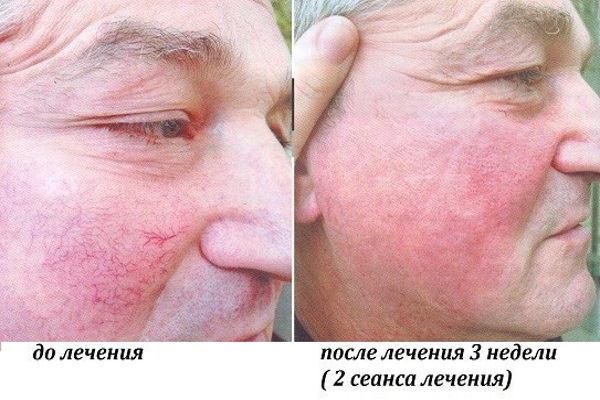 До и после лечения купероза методом фототерапии