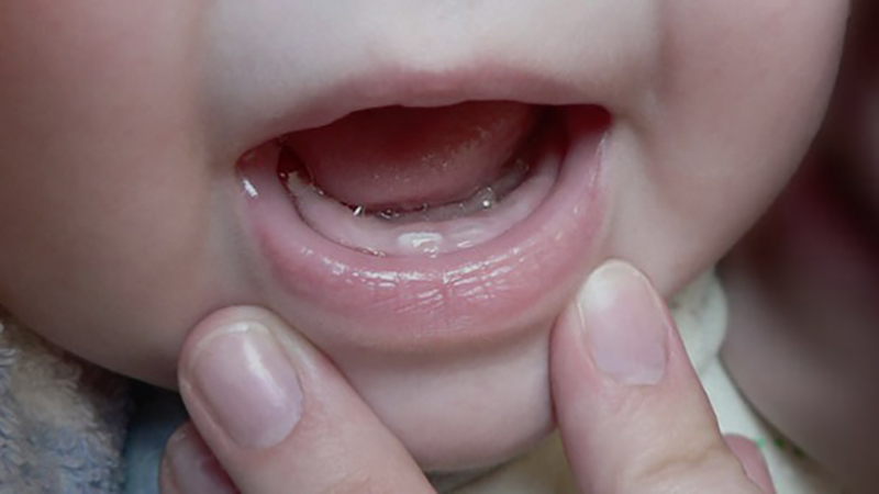 Состояние десен при прорезывании зубов у детей