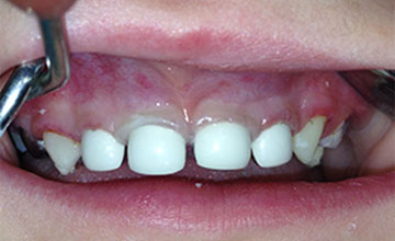 Гипоплазия эмали молочных зубов у ребенка причины и лечение