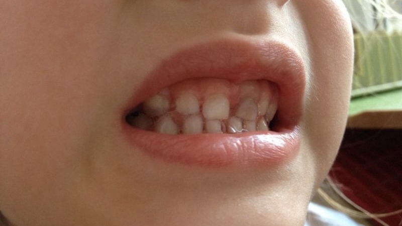 Почему у ребенка шатается молочный зуб? Что делать в этой ситуации