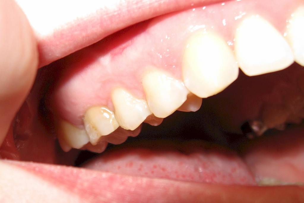 Симптомы и лечение кисты зуба. Чем опасно новообразование в ротовой полости