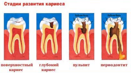 Можно ли делать отбеливание мертвого зуба, или зуба с пломбой. Раскрываем секреты