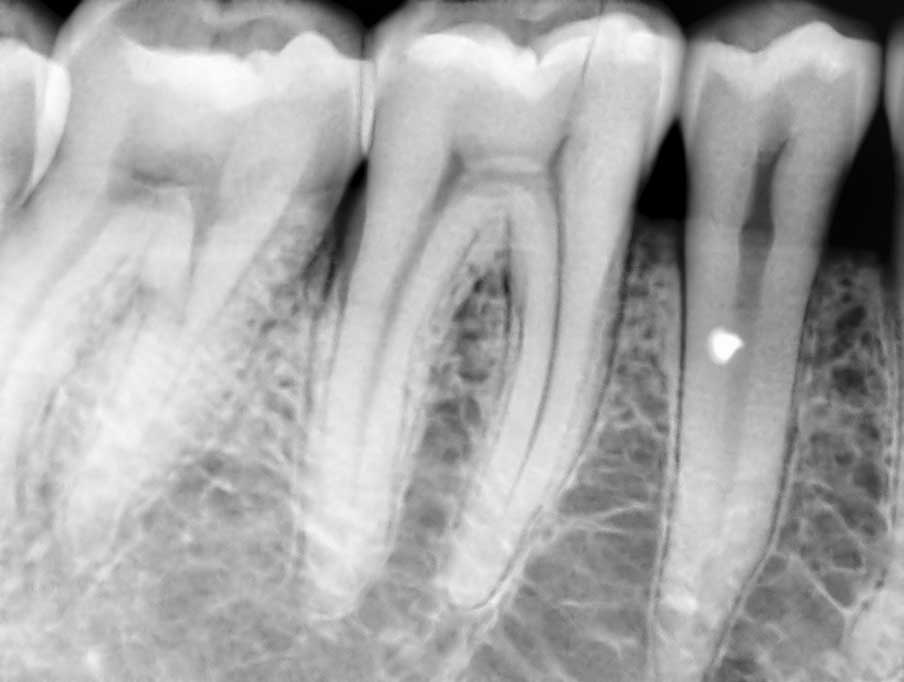 Что такое экзостоз в стоматологии: костный нарост на десне. Как происходит удаление