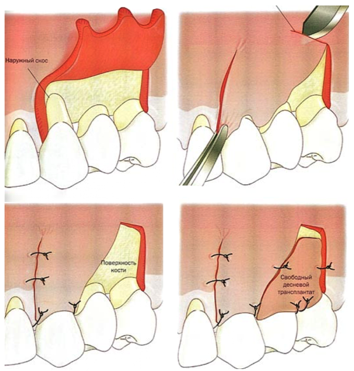 Что делать, если десна отошла от зуба. Обязательно ли делать операцию