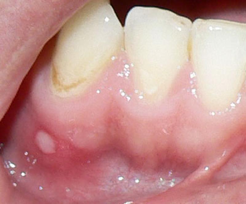 Что делать, если появился белый прыщ на десне на зубом у взрослого или ребенка? Срочно бегите к врачу
