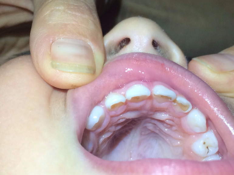 Анестезия в детской стоматологии больно ли лечить молочные зубы у детей