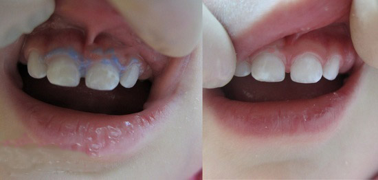 Зачем делать серебрение зубов у детей