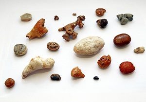 камни в почках фото