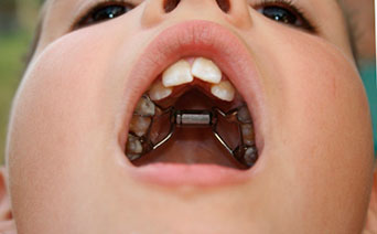 Некрасивая проблема кривые зубы у детей. Методы выравнивания