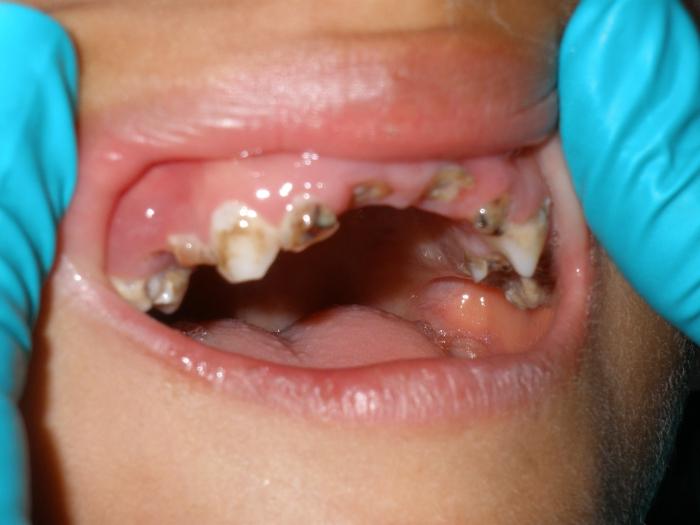 Опасное явление гнилые зубы у детей