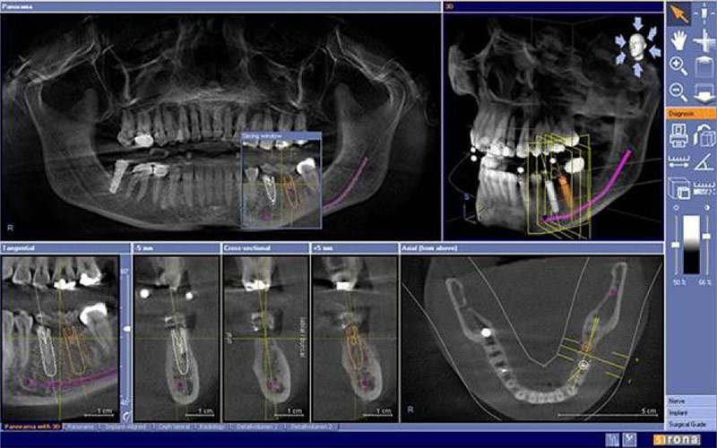 Как происходит имплантация передних зубов. Все этапы процедуры