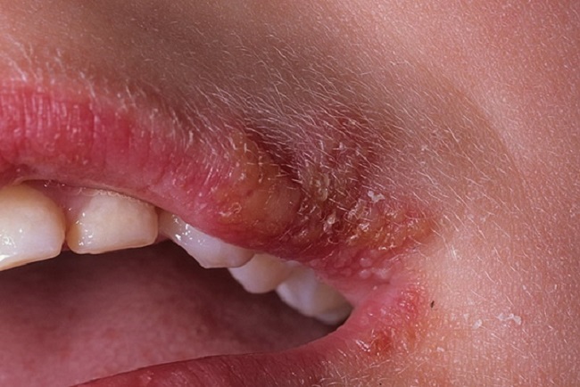 Причины появления герпеса на губах