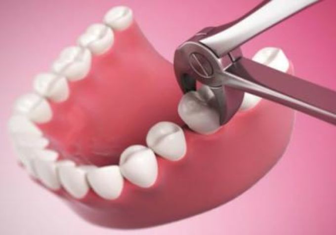 Когда можно чистить зубы после удаления? И ещё 7 полезных советов