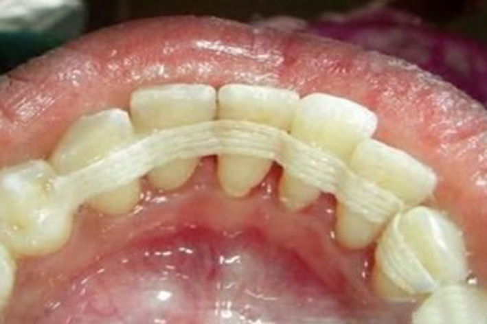 Не доводите дело до скальпеля! Комплексное лечение пародонтита у стоматолога и в домашних условиях