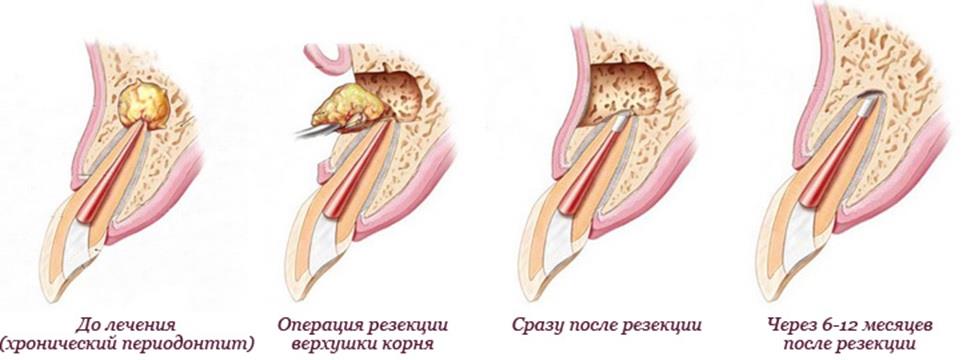 Что делать, если под коронкой образовалась киста зуба? Как избежать осложнений