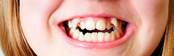 Некрасивая проблема кривые зубы у детей. Методы выравнивания