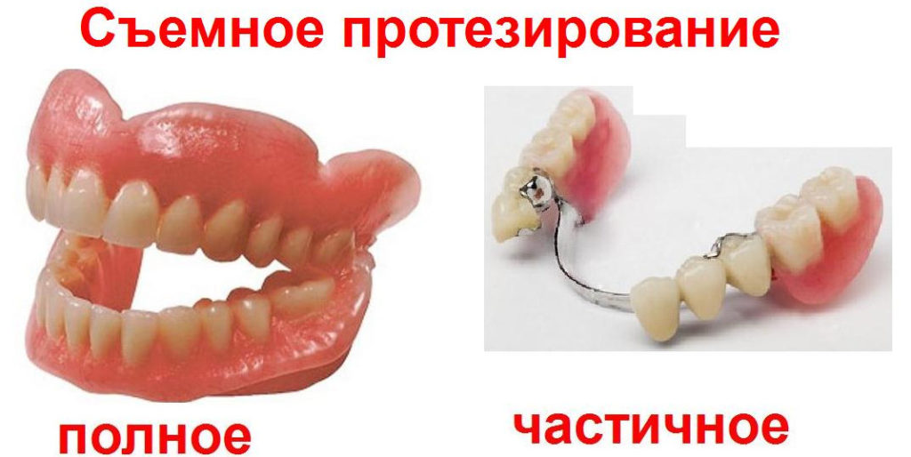 Чем хороши съемные зубные протезы Акри Фри. Что перевесит: достоинства или недостатки