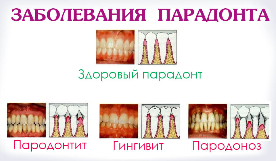 Одно хуже другого. Пародонтит и пародонтоз: в чем отличие