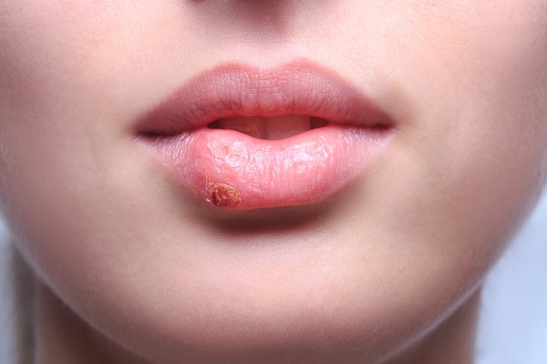 Как долго бывает заразен герпес на губах